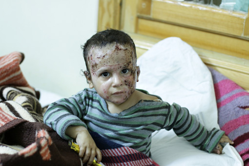 火傷を負ったシリアの男の子。民間人を巻き込む無差別攻撃で人びとは追い詰められている ©MSF